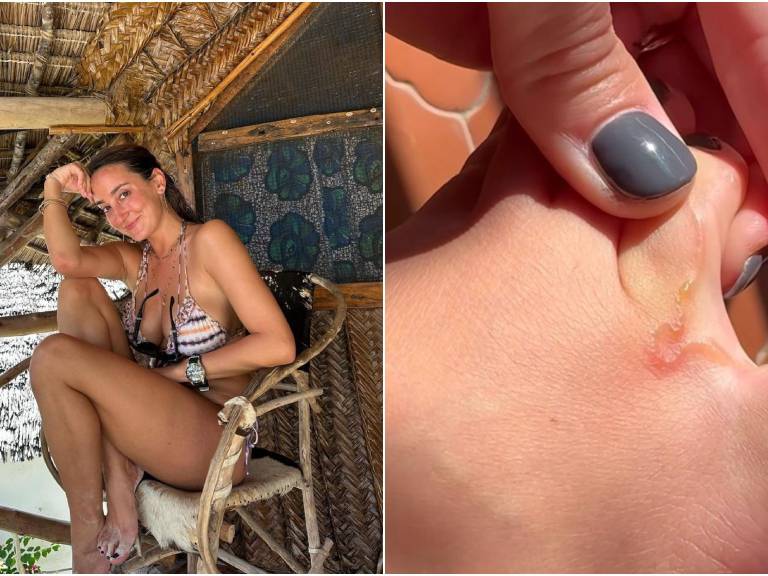 Volvía de un viaje a Tanzania: influencer española descubre que tiene un gusano vivo dentro del pie