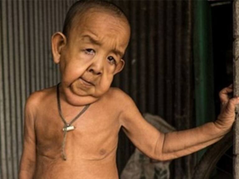 La asombrosa historia del «Benjamin Button» de Bangladesh