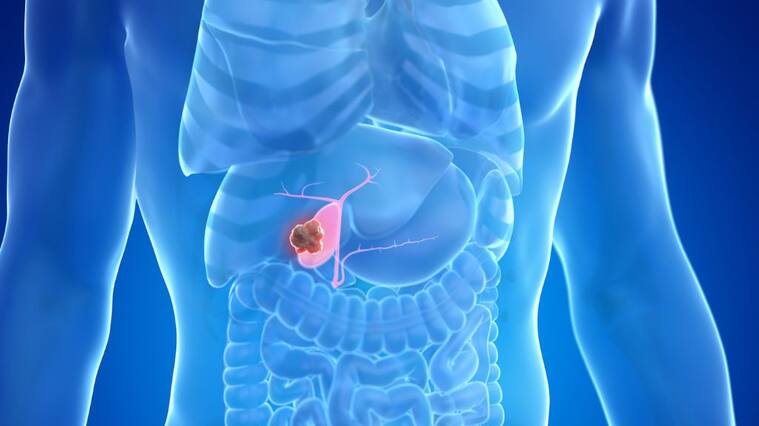 Cáncer de vesícula biliar - tratamientos