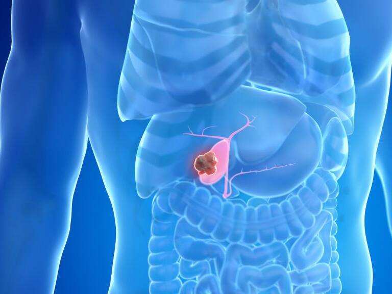 Cáncer de vesícula biliar - tratamientos