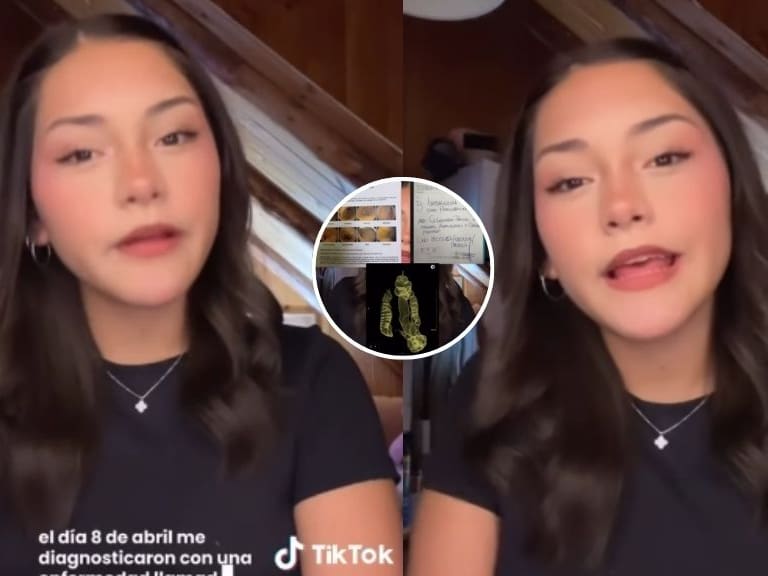 Joven chilena de 17 años pide ayuda urgente: necesita $50 millones para cirugía en el extranjero