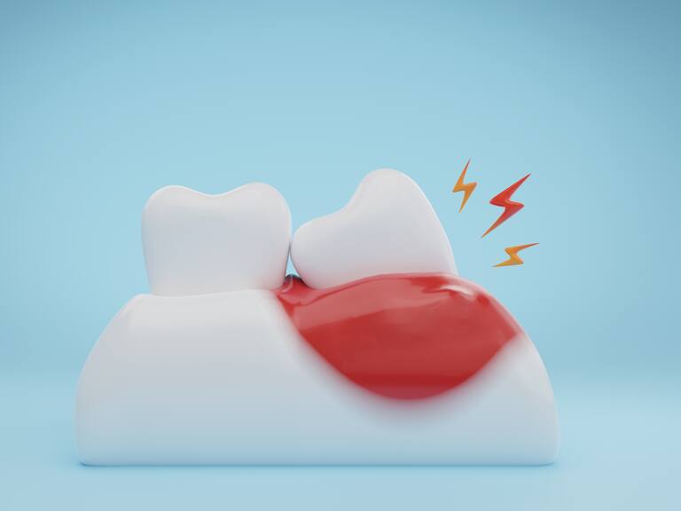 Gums and teeth disease wisdom tooth infection on blue background. 3D rendering.