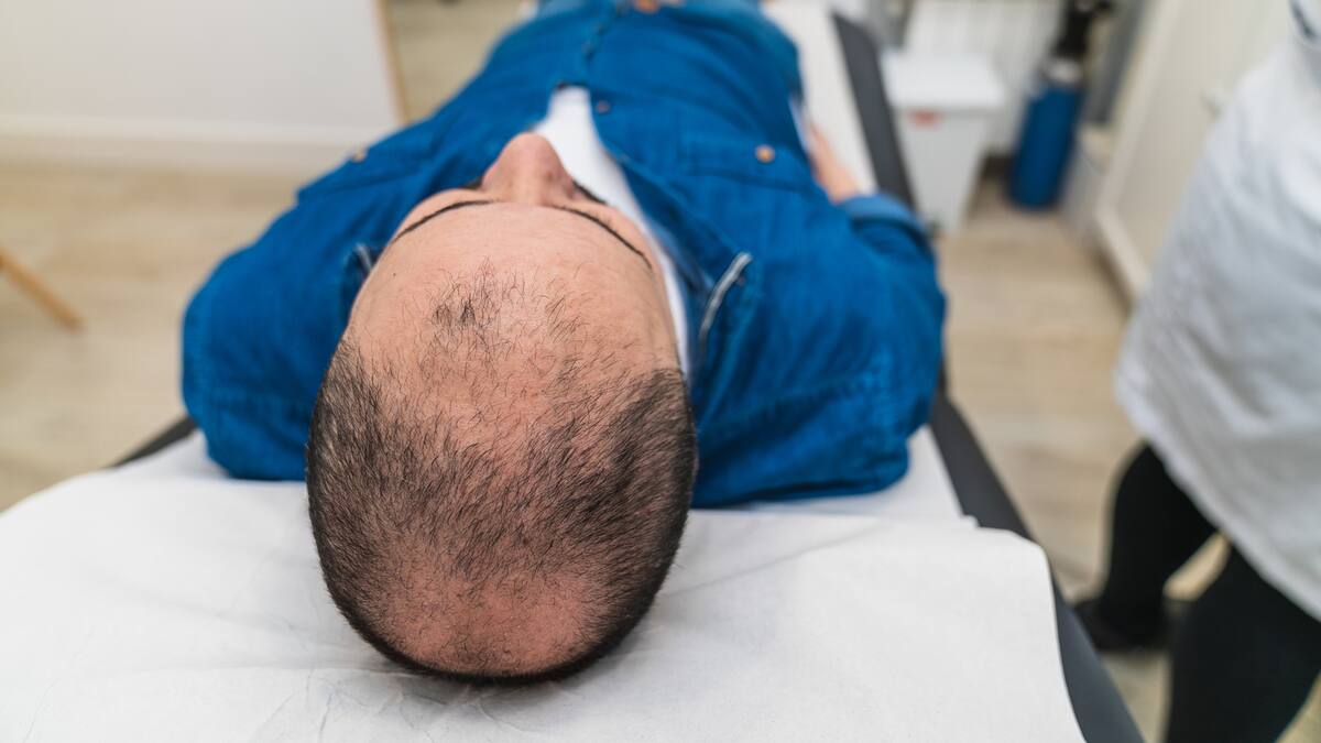 Cada vez más jóvenes: esta es la edad en que los hombres están consultando por implante capilar en Chile