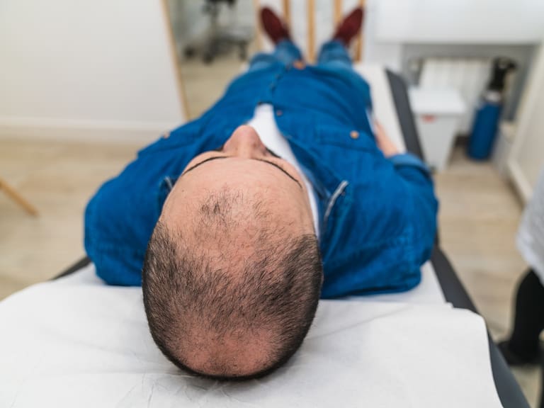 Cada vez más jóvenes: esta es la edad en que los hombres están consultando por implante capilar en Chile