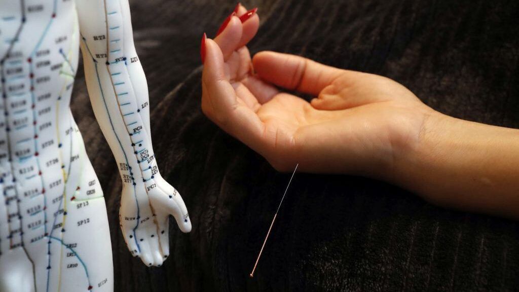 Traditional chinese medecine. A male model with marked acupuncture points. Woman receving acupuncture needle. France. (Photo by: Godong/Universal Images Group via Getty Images)