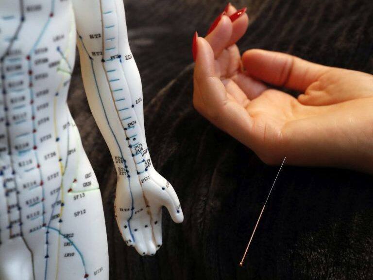Traditional chinese medecine. A male model with marked acupuncture points. Woman receving acupuncture needle. France. (Photo by: Godong/Universal Images Group via Getty Images)