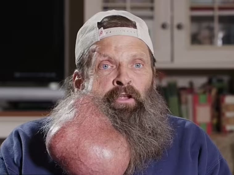 “Comenzó como un grano”: hombre desarrolla tumor del tamaño de una sandía en su cuello