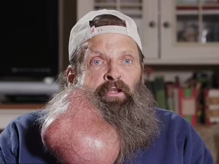 “Comenzó como un grano”: hombre desarrolla tumor del tamaño de una sandía en su cuello