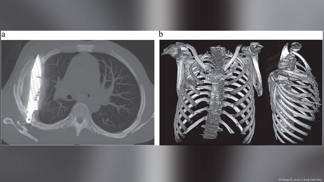 Imagen: Kivuyo N. et al./J Surg Case Rep