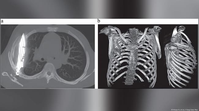Imagen: Kivuyo N. et al./J Surg Case Rep