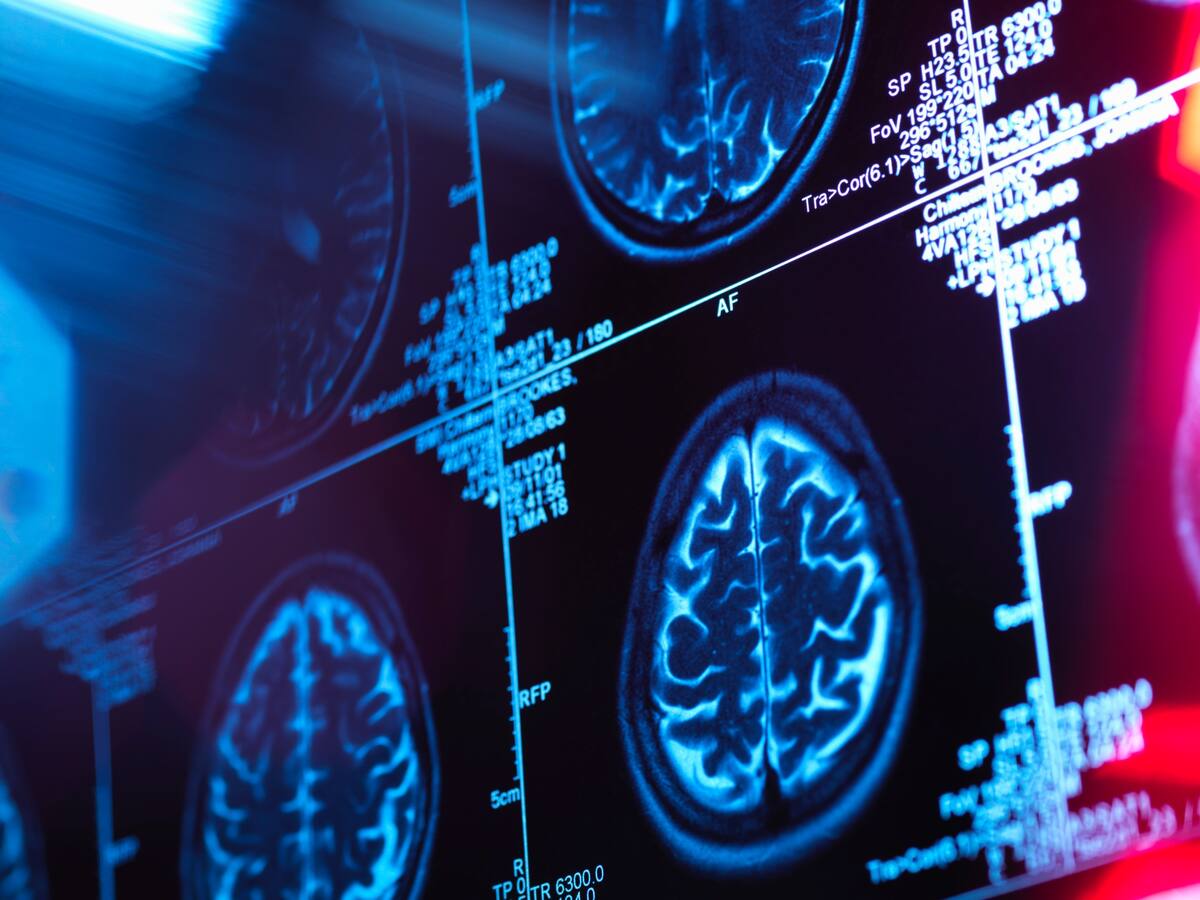 Las primeras cosas que una persona olvida antes de desarrollar Alzheimer