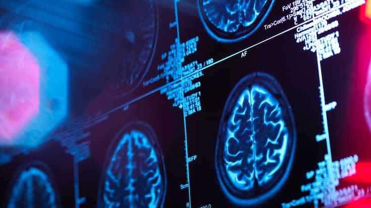 FDA aprueba primer tratamiento contra el alzhéimer que se puede administrar en casa