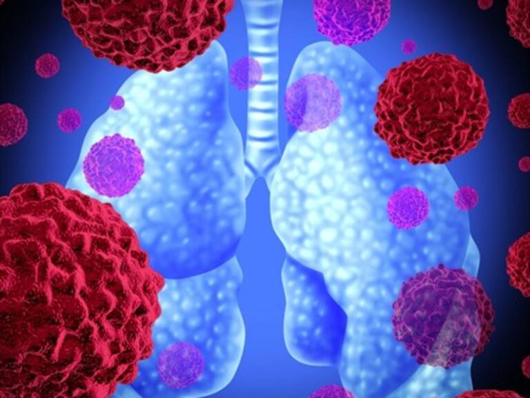 El cáncer de pulmón también afecta a no fumadores