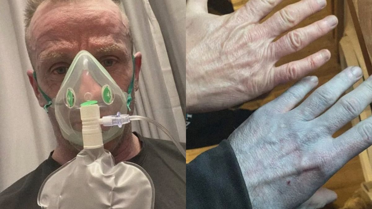 Despertó con la piel azul y acudió a urgencias pero una toallita con alcohol reveló la cómica verdad