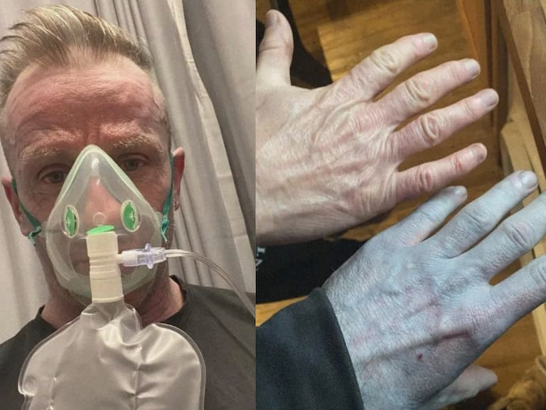 Despertó con la piel azul y acudió a urgencias pero una toallita con alcohol reveló la cómica verdad