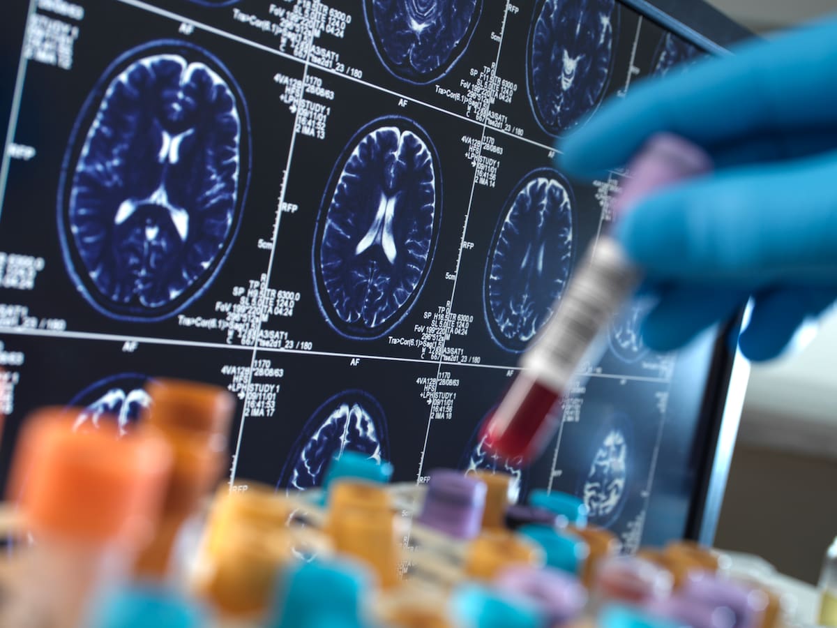 Adiós a lo que sabíamos: científicos proponen que el Alzheimer podría ser en realidad un tercer tipo de diabetes