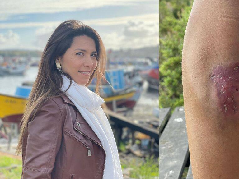 «Ahora tengo una cicatriz que cuenta esta historia»: Loreto Aravena celebra su mejora tras ser mordida por araña de rincón