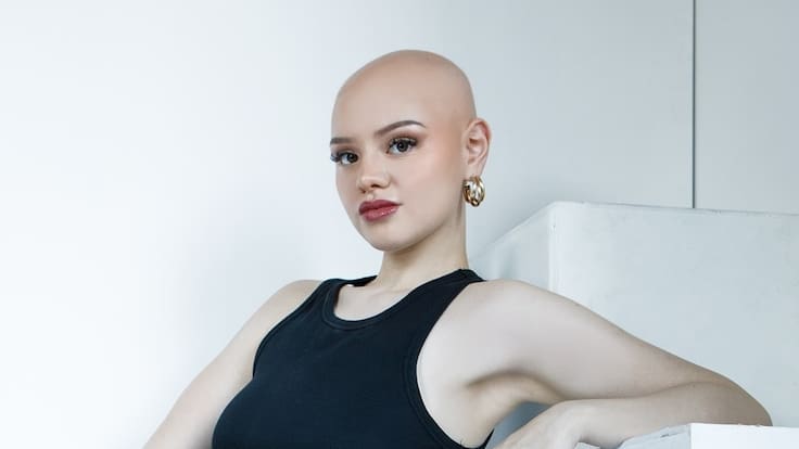 “Mi alopecia se transformó en mi sello, no sería yo si me pusiera peluca”