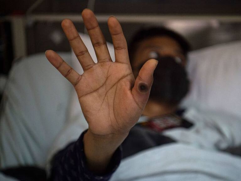 Paciente en Perú muestra las lesiones que causa la viruela del mono