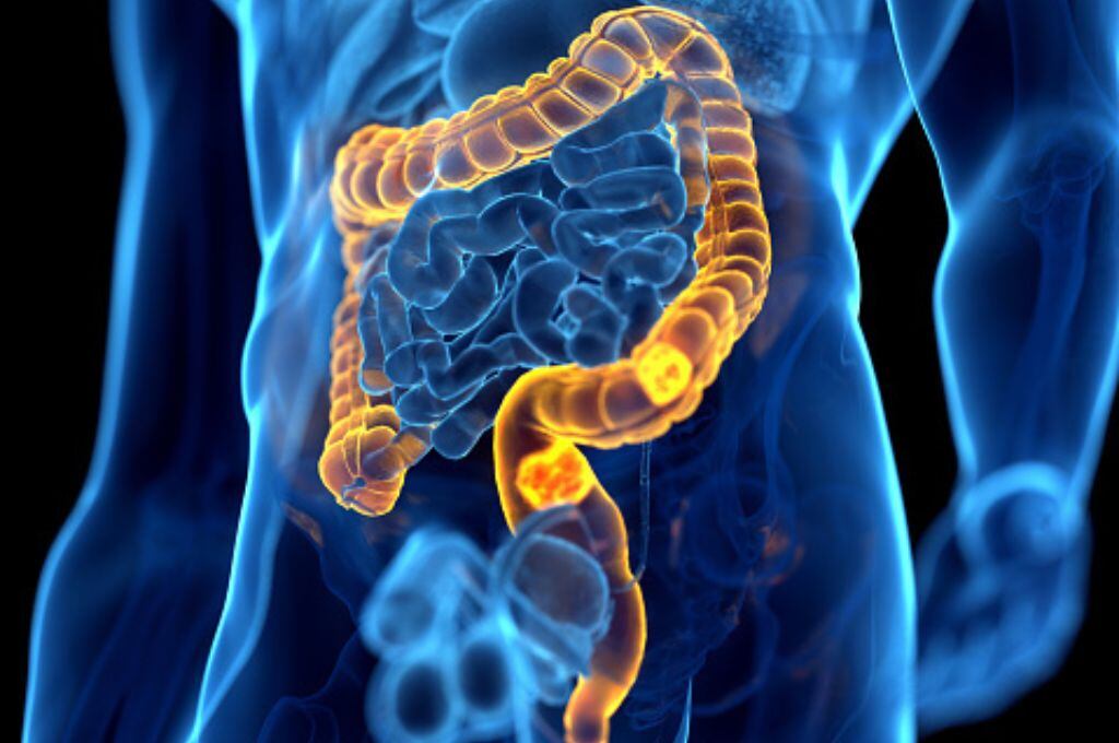 Día Mundial del Cáncer de Colon: Presidente de la Fundación para el Desarrollo de la Oncología nos explica los síntomas a considerar