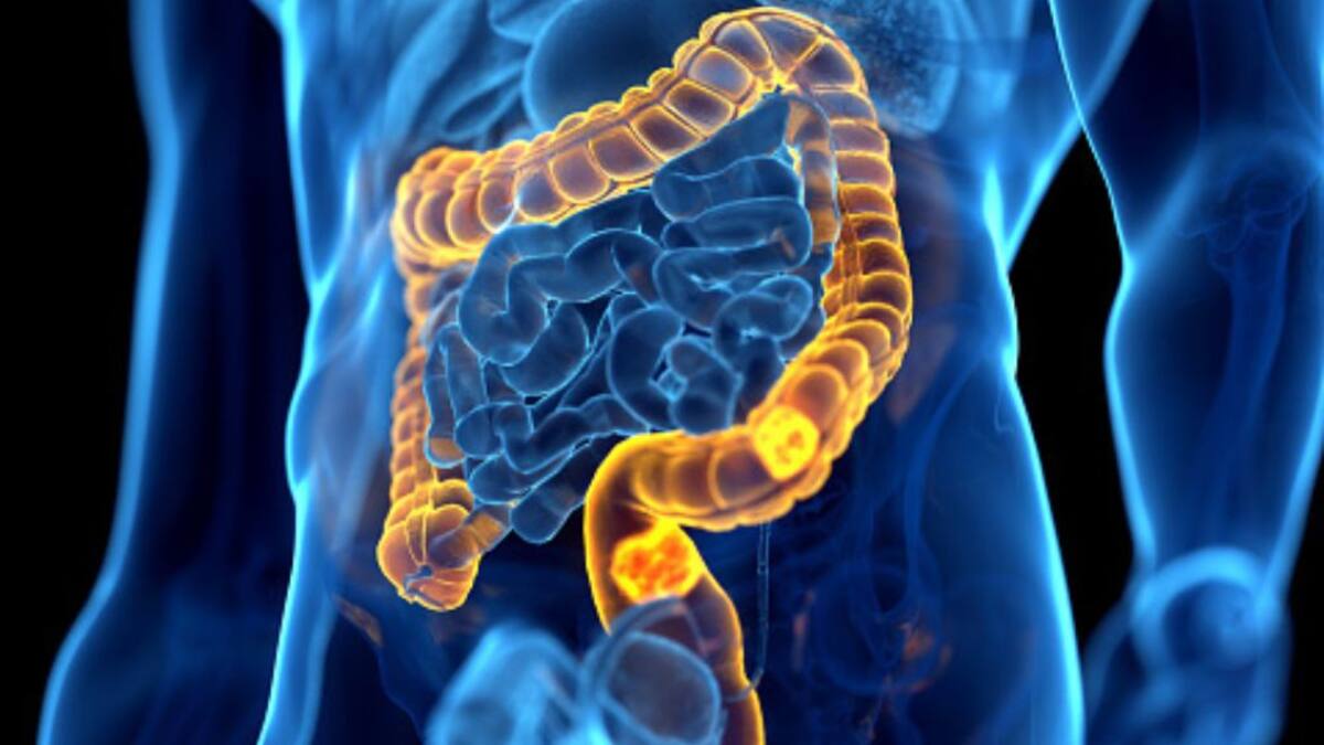 Día Mundial del Cáncer de Colon: presidente de la Fundación para el Desarrollo de la Oncología nos explica los síntomas a considerar