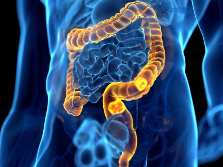 Día Mundial del Cáncer de Colon: Presidente de la Fundación para el Desarrollo de la Oncología nos explica los síntomas a considerar