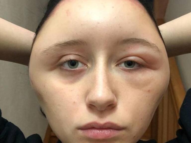 Joven francesa sufrió una deformación craneal por teñirse el pelo