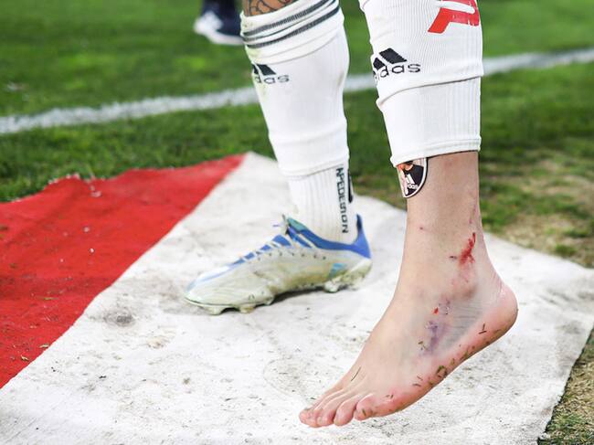 Tobillo izquierdo de Maximiliano Falcón tras enfrentar a Huachipato. (Foto: Agencia Uno)