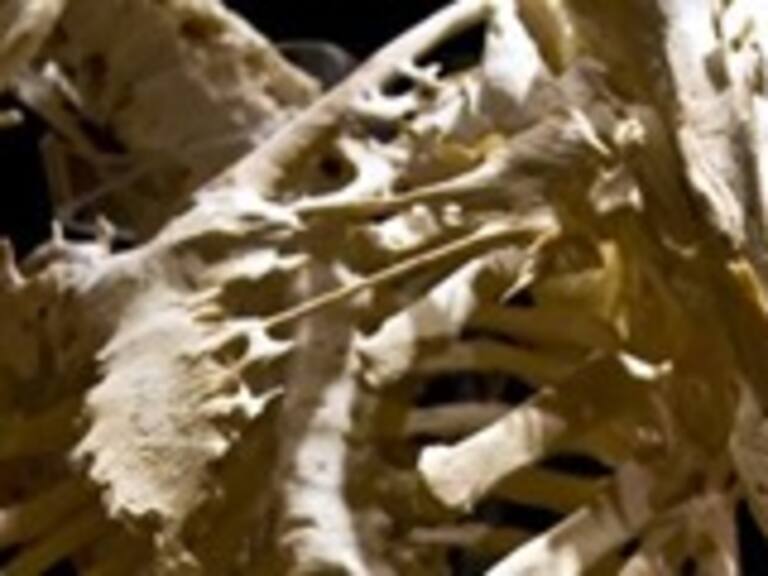 Estudio entrega clave para tratar enfermedad rara que convierte músculos en hueso