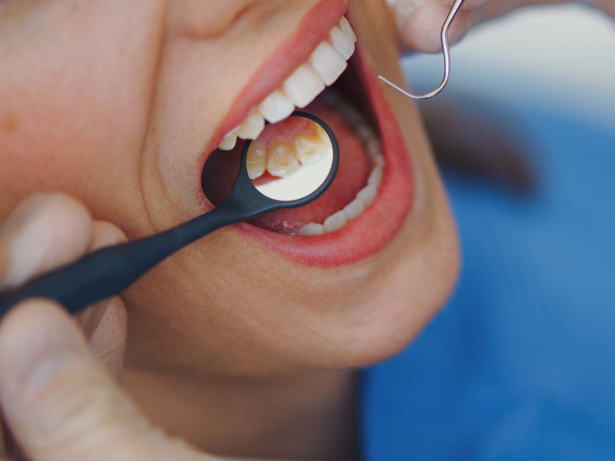 Científicos vinculan la pérdida de piezas dentales con graves enfermedades vasculares