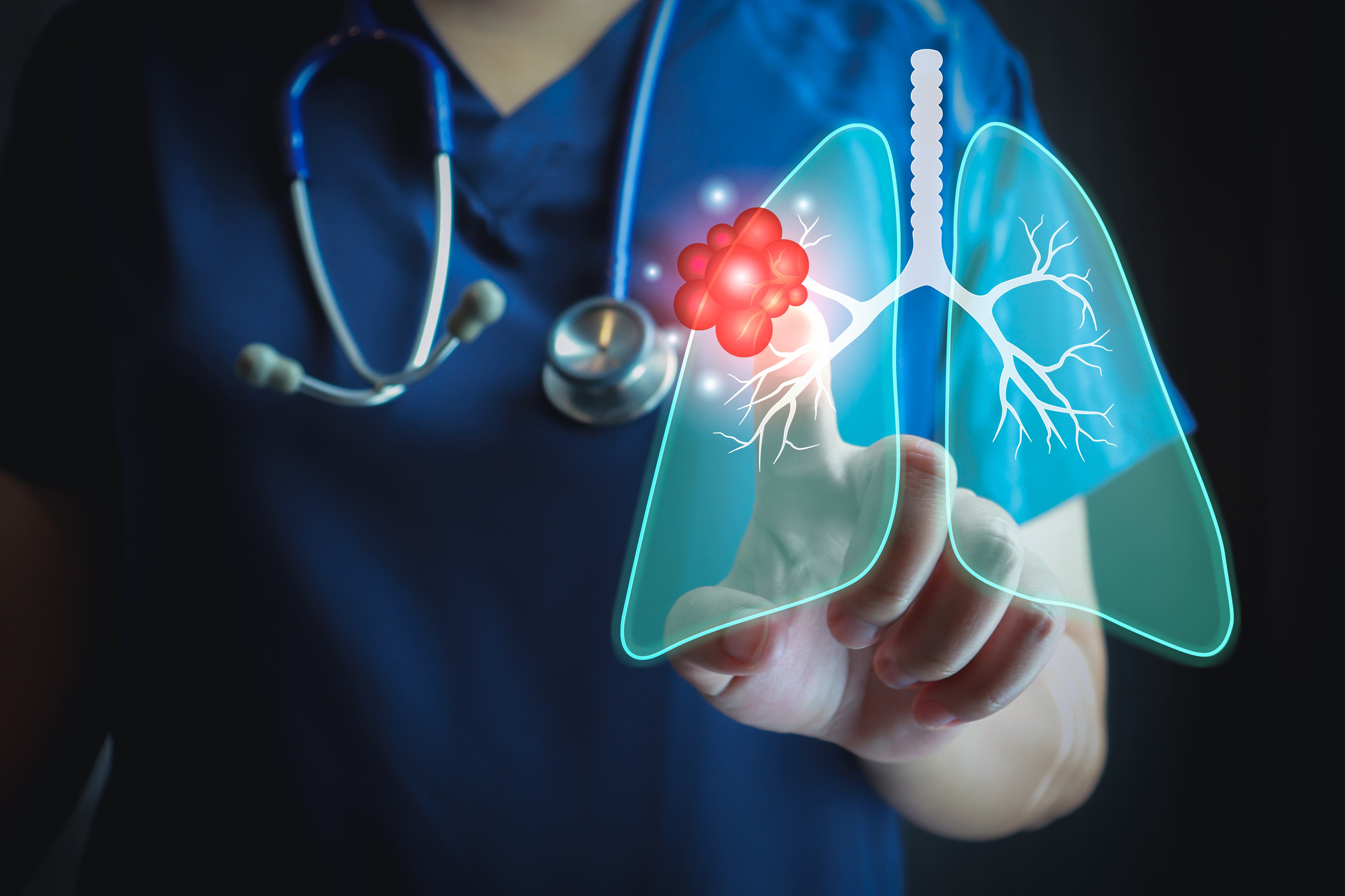 Más del 12% de las muertes en Chile: cáncer de pulmón concentra la mayor mortalidad en el país