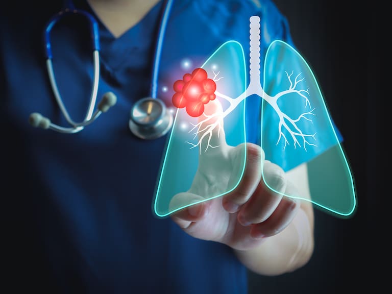 Más del 12% de las muertes en Chile: cáncer de pulmón concentra la mayor mortalidad en el país