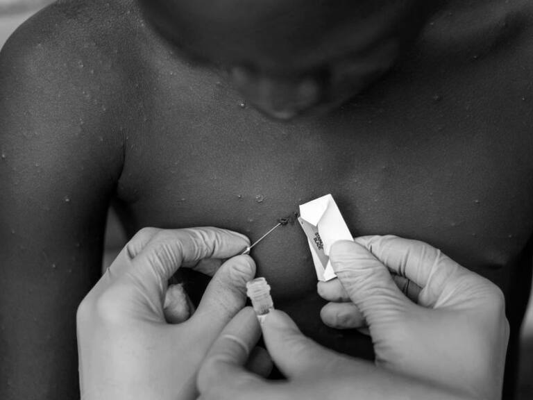 Viruela del mono: ¿Cómo se contagia en los humanos y cuáles son los síntomas?