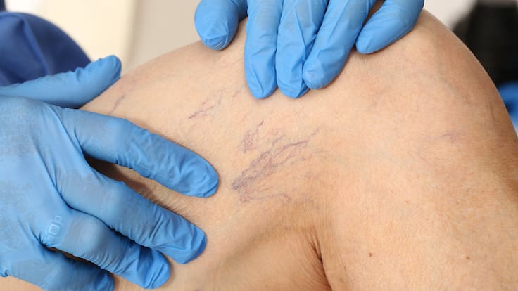 Enfermedad venosa crónica afecta al 80% de la población: expertos llaman a reconocer síntomas