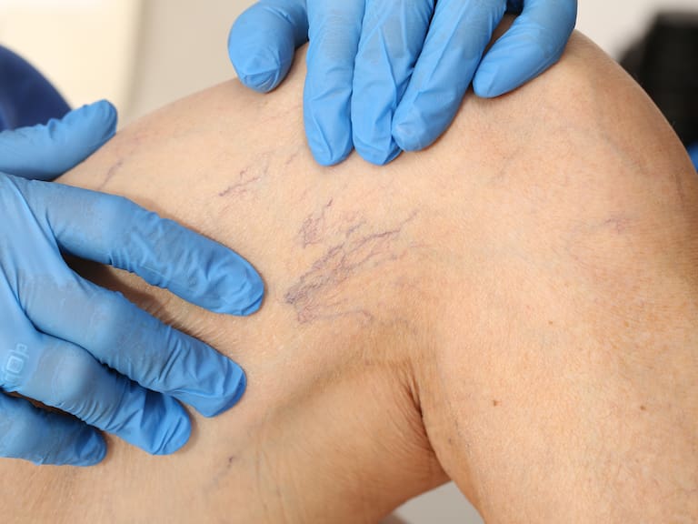 Enfermedad venosa crónica