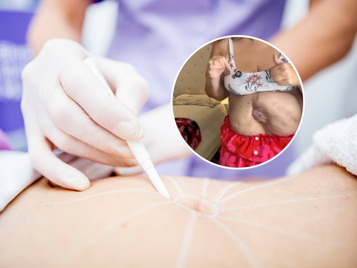 “Movilizaron mis intestinos con las manos”: la desgarradora historia de la influencer que sobrevivió sin estómago tras una cirugía estética fallida