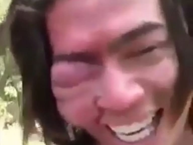 Amigos explotan de la risa al ver sus caras tras varias picaduras de abeja