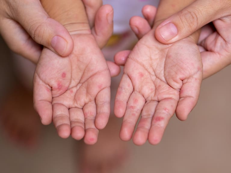 Está al alza en el norte de Chile: qué es la enfermedad de boca, mano y pie que afecta especialmente a niños