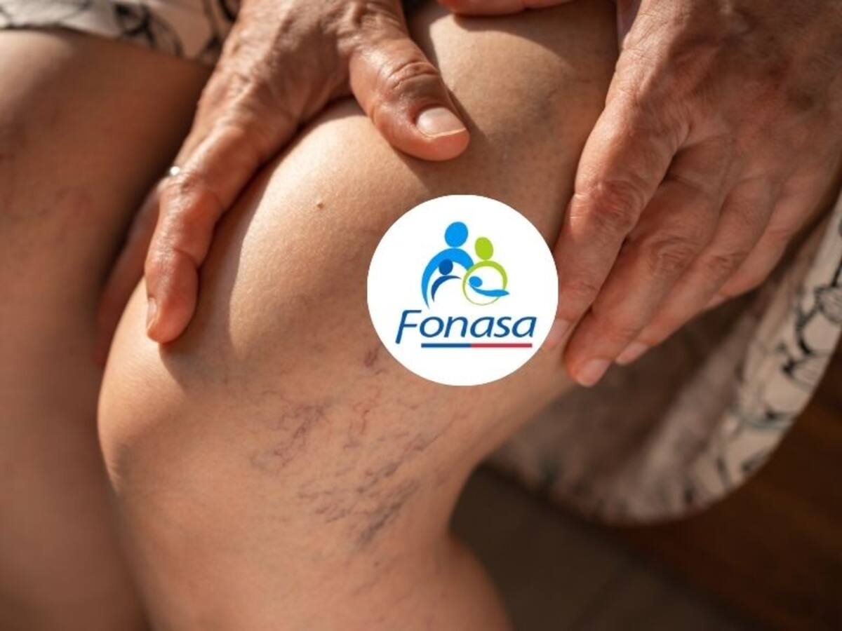 Várices con Fonasa: así funciona el Bono PAD y cuánto cuesta el tratamiento quirúrgico