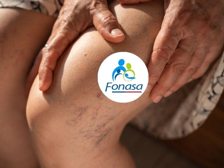 Várices con Fonasa: así funciona el Bono PAD y cuánto cuesta el tratamiento quirúrgico