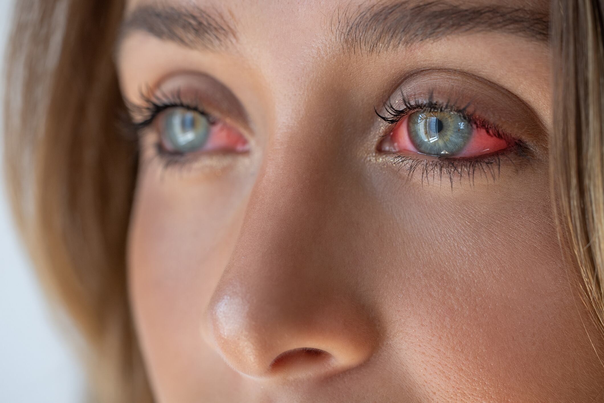 Red eye suffering from allergy