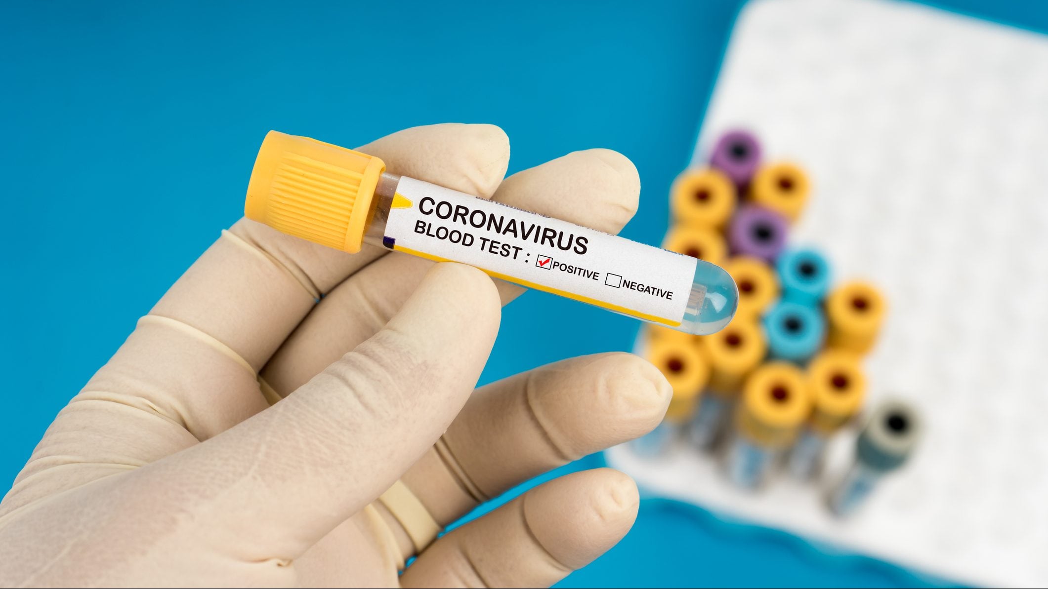 Una muestra da positivo en el test del Covid-19