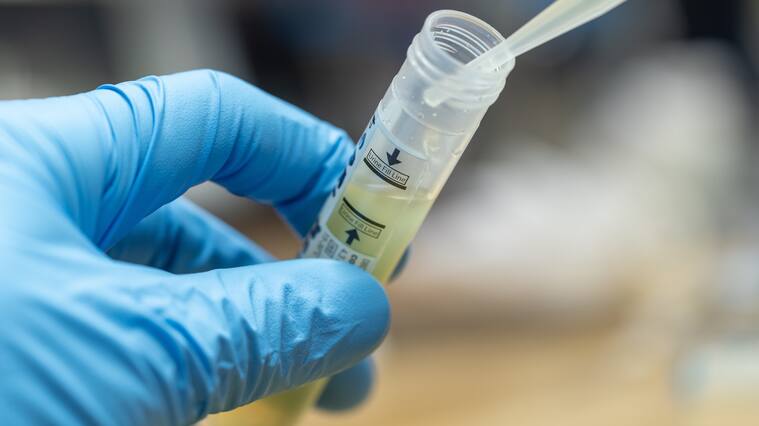 A urine sample collection tube for chlamydia PCR (polymerase chain reaction) testing which is commonly used in the laboratory to screen patients for chlamydia infection.