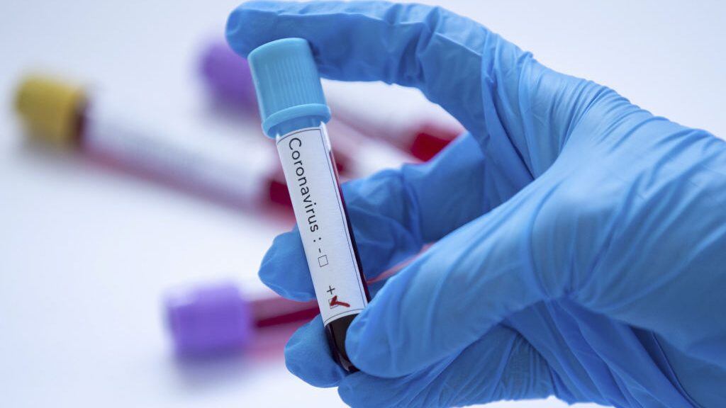 ANKARA, TURKEY - FEBRUARY 14: In this photo illustration a coronavirus (2019-nCoV) positive blood sample is displayed on February 14, 2020 in Ankara, Turkey. Aytac Unal / Anadolu Agency