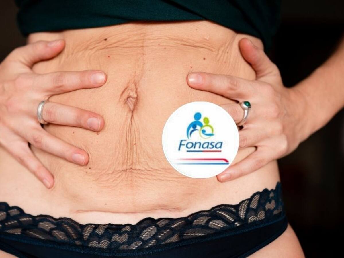 Abdomen flácido con Fonasa: cuánto cuesta la cirugía y cómo funciona el Bono PAD (paso a paso)