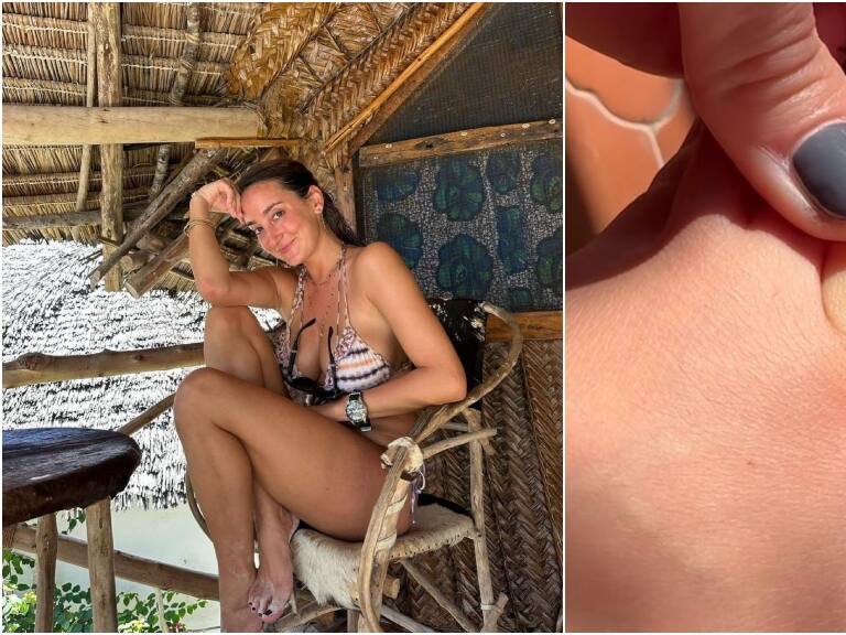 Volvía de un viaje a Tanzania: influencer española descubre que tiene un gusano vivo dentro del pie