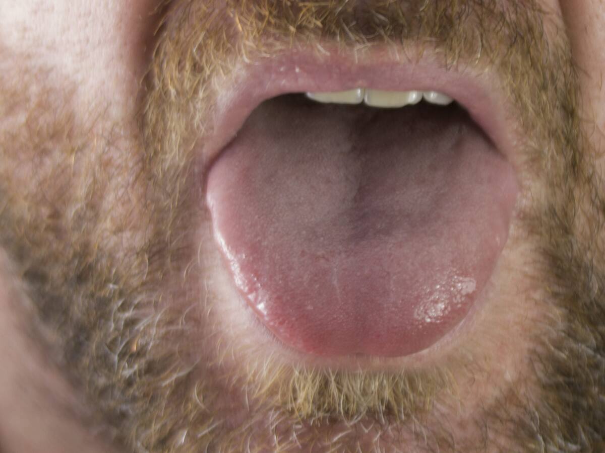 «Lengua covid»: Estudio describe nuevo síntoma de pacientes con coronavirus