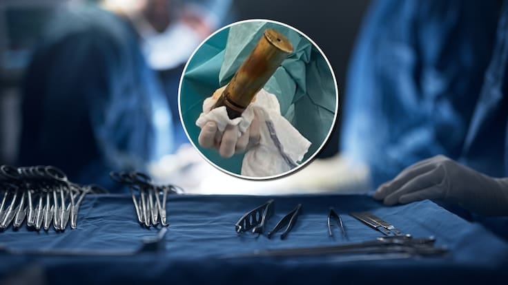 Insólita emergencia en Francia: médicos extraen peligroso proyectil de la Primera Guerra Mundial desde el recto de un hombre