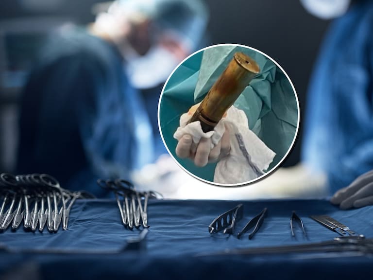Insólita emergencia en Francia: médicos extraen peligroso proyectil de la Primera Guerra Mundial desde el recto de un hombre