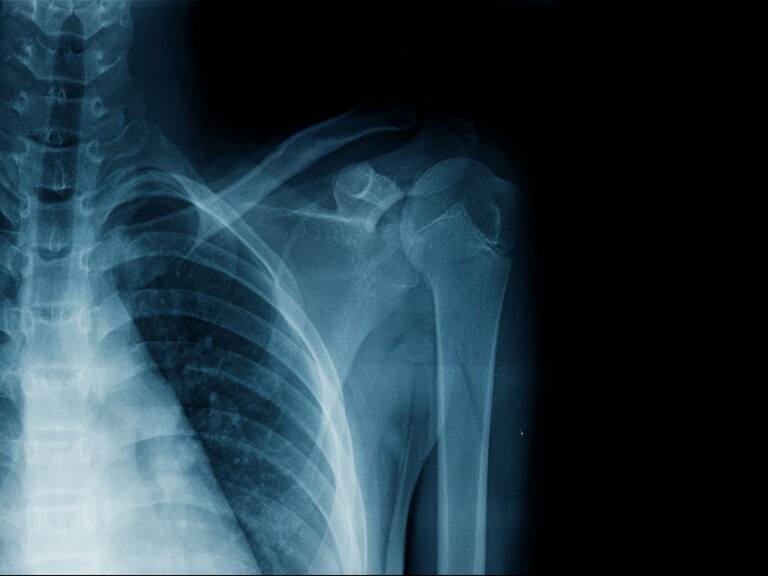 Pacientes con Fibrosis Pulmonar Idiopática ya cuentan con más de 8 mil firmas para incluir la enfermedad en el GES